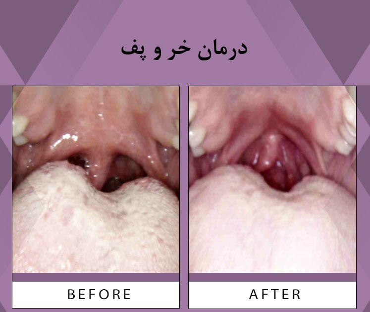 درمان خروپف             