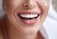 لمینت دندان و انواع روش های دندانپزشکی زیبایی