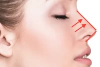 راهنمایی و نکات مهم درباره لیفت بینی استخوانی