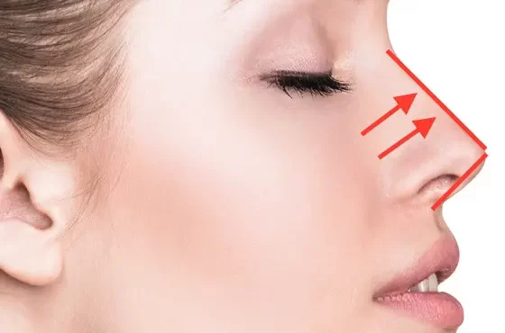 راهنمایی و نکات مهم درباره لیفت بینی استخوانی