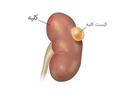 علائم و روشهای درمان کیست کلیه علائم و روشهای درمان کیست کلیه
