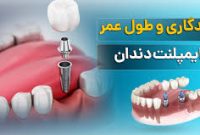 آیا ایمپلنت دندان مادام‌العمر است؟