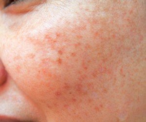 روشهای مؤثر برای از بین بردن لکهای پوستی روشهای مؤثر برای از بین بردن لکهای پوستی