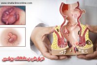 عوارض وحشتناک بواسیر : آیا شما هم در خطر هستید؟