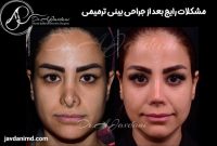 مشکلات رایج بعد از جراحی بینی ترمیمی
