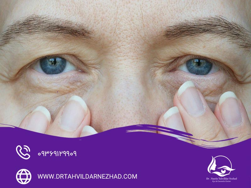 علت کوچک شدن چشم بعد از عمل بلفاروپلاستی چیست؟