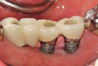 نشانه های عفونت ایمپلنت دندان