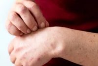 شناخت آلرژی لاتکس؛ از علائم اولیه تا روش‌های درمان و اجتناب از تماس