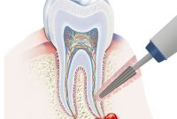 آیا عفونت دندان در کودکان خطرناک است؟ آیا عفونت دندان در کودکان خطرناک است؟
