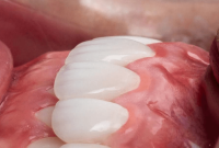 تفاوت ایمپلنت با لمینت و کامپوزیت | مقایسه کاربرد و طول عمر تفاوت ایمپلنت با لمینت و کامپوزیت | مقایسه کاربرد و طول عمر