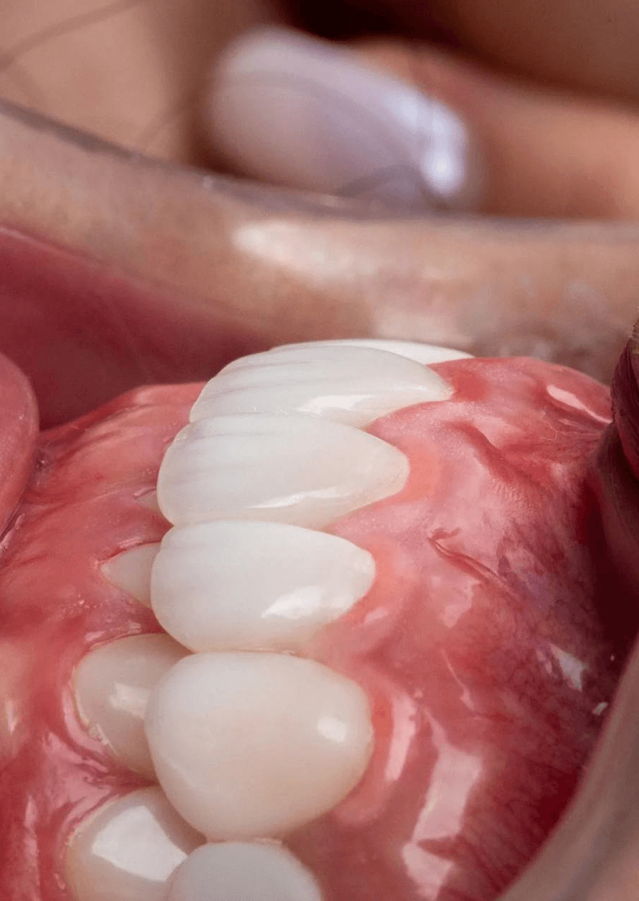 تفاوت ایمپلنت با لمینت و کامپوزیت | مقایسه کاربرد و طول عمر تفاوت ایمپلنت با لمینت و کامپوزیت | مقایسه کاربرد و طول عمر