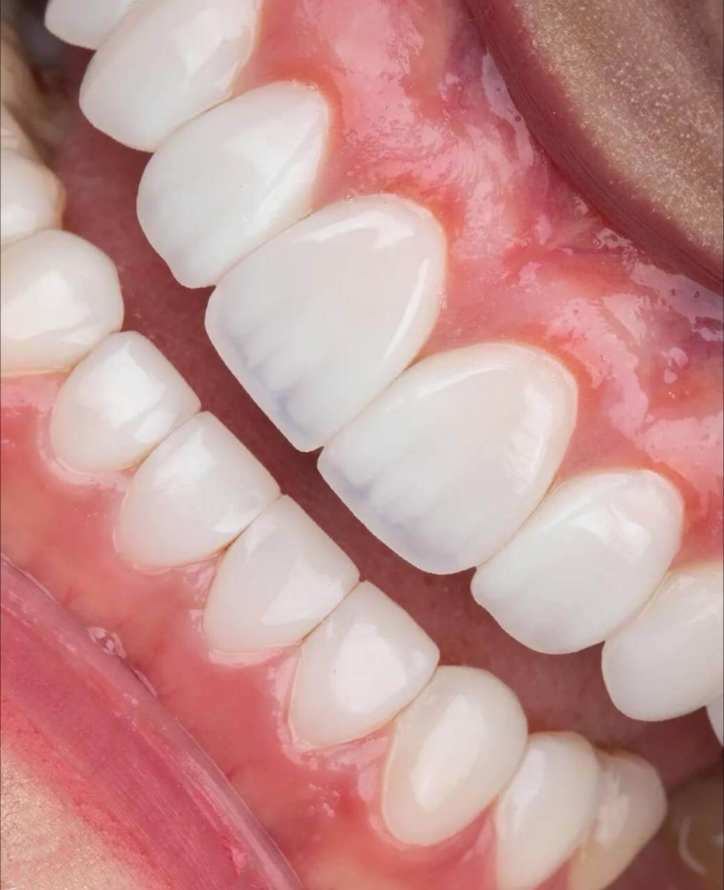 تفاوت ایمپلنت با لمینت و کامپوزیت | مقایسه کاربرد و طول عمر تفاوت ایمپلنت با لمینت و کامپوزیت | مقایسه کاربرد و طول عمر