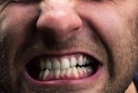 آیا استفاده از محافظ دندان قروچه با بریس امکان‌پذیر است؟