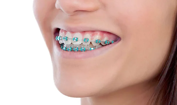آیا ارتودنسی فقط جنبه زیبایی دارد؟ وقتی یک درمان، آینده سلامت دندان‌ها را تغییر می‌دهد