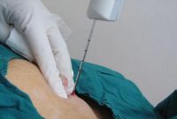سوزن بیوپسی چیست و هنگام خرید آن باید به چه نکاتی توجه کرد؟