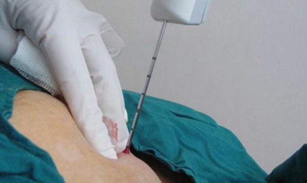 سوزن بیوپسی چیست و هنگام خرید آن باید به چه نکاتی توجه کرد؟